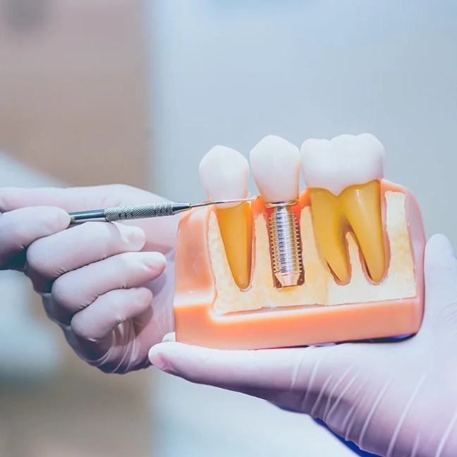 Why should I choose dental implants?